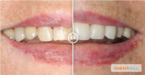 Dentista em Jundiaí - Facetas de porcelana - Dental Care Jundiaí