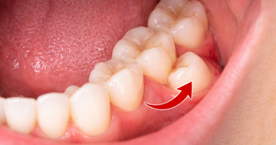 Dente do Siso Nascendo Torto em Jundiaí - Clínica Odontológica Dental care Jundiaí
