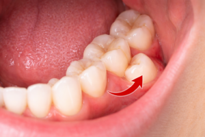 Dente do Siso Nascendo Torto em Jundiaí - Clínica Odontológica Dental care Jundiaí