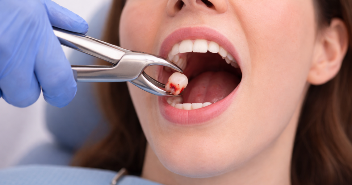 Extração do dente do siso em Jundiaí - Clínica Odontológica Dental Care