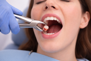 Extração do dente do siso em Jundiaí - Clínica Odontológica Dental Care