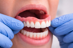 Prótese Dentária em Jundiaí - Dentista em Jundiaí - Dental Care