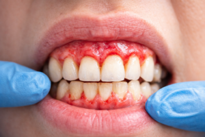 Tratar Doença na Gengiva - Periodontia em Jundiaí - Dental Care Jundiaí