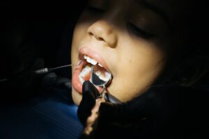 Cárie Dental em Criança em Jundiaí - Dentista em Jundiaí