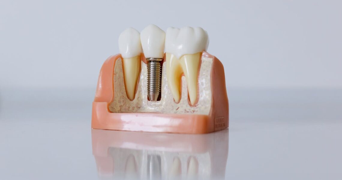 Implante Dentário em Jundiaí - Clínica Odontológica Dental Care Jundiaí