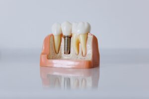 Implante Dentário em Jundiaí - Clínica Odontológica Dental Care Jundiaí