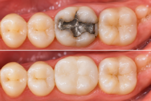 Trocar Restauração Antiga Escura em Jundiaí - Clínica Dental Care Jundiaí